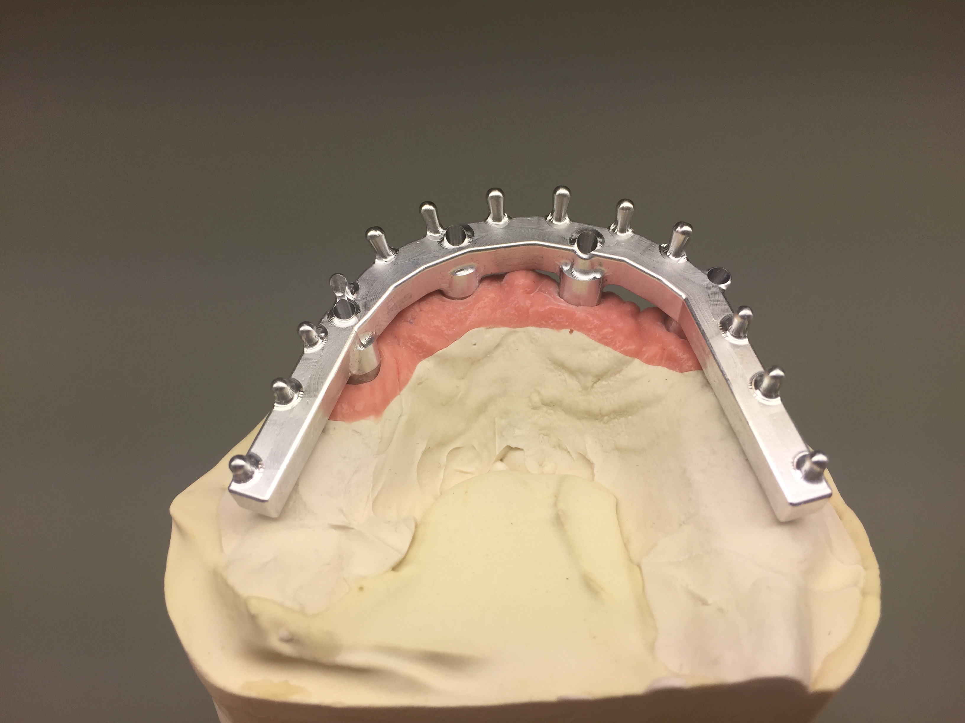 Bar Overdenture Screw-Retained
