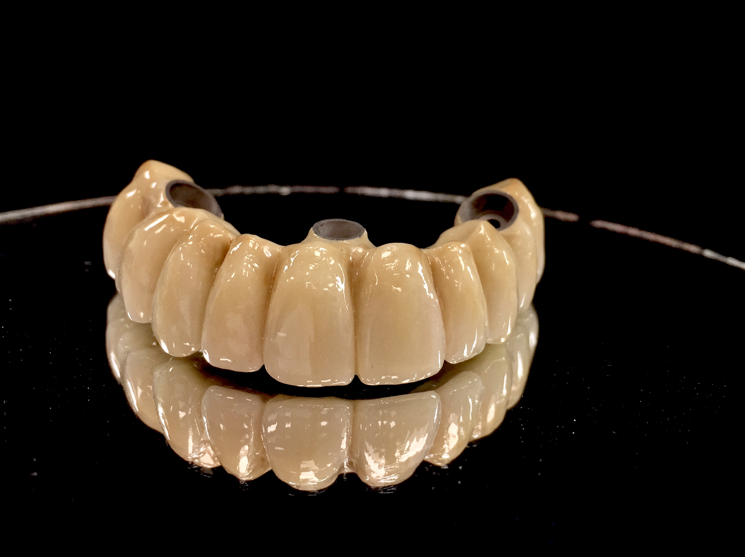 Bar Overdenture