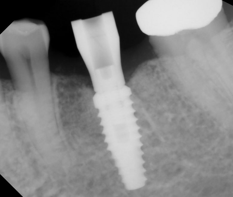 Ensure scanning abutment is fully seated